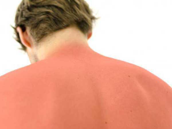 آفتاب سوختگی چیست و چطور درمان می شود؟